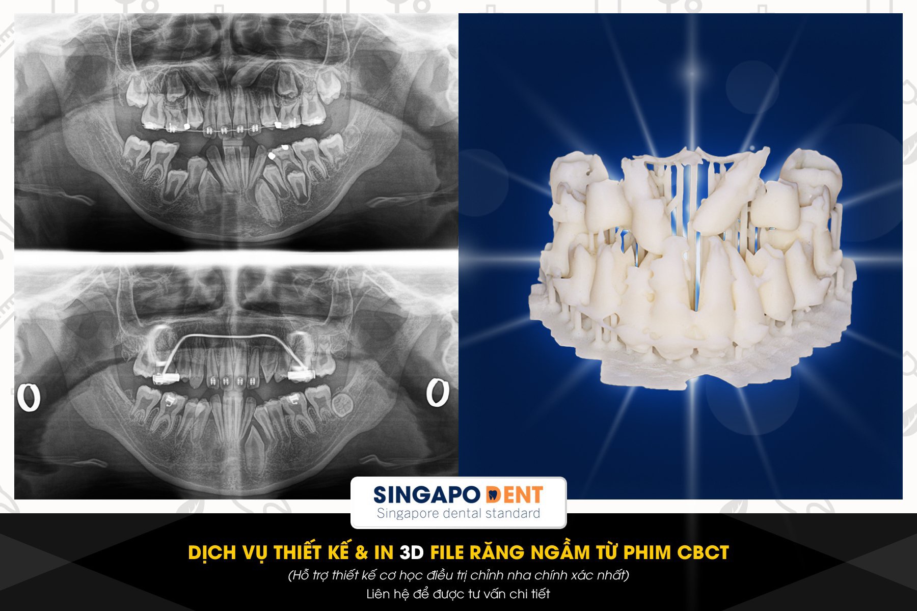 Dịch vụ làm khay duy trì sau chỉnh nha