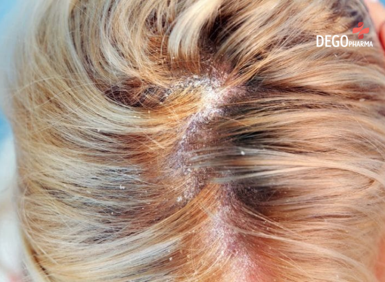 nấm da đầu có lan xuống mặt