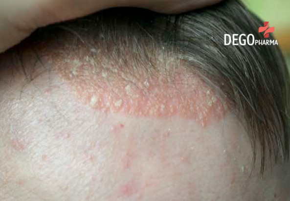 chữa viêm da tiết bã bằng dân gian