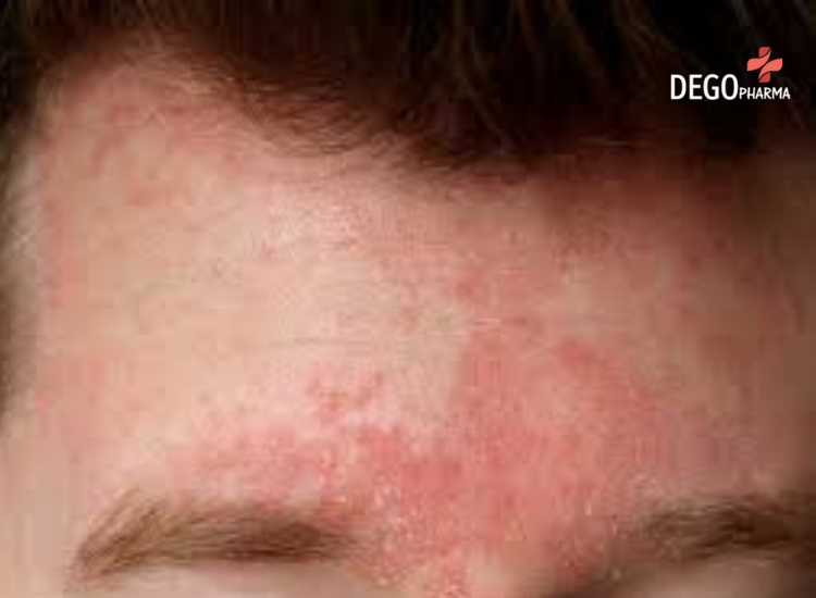 chữa viêm da tiết bã bằng dân gian