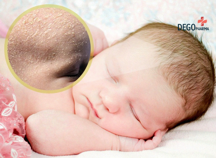 dấu hiệu viêm da đầu