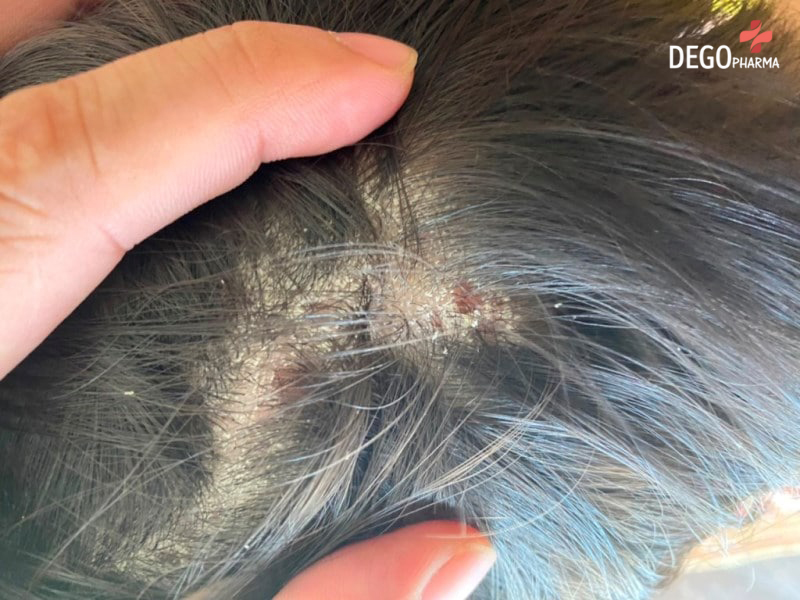 Thuốc trị nấm da đầu nào tốt nhất hiện nay?