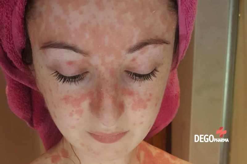 Vảy nến da mặt