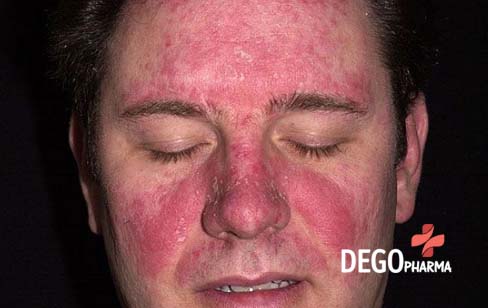 Bệnh vẩy nến ở mặt