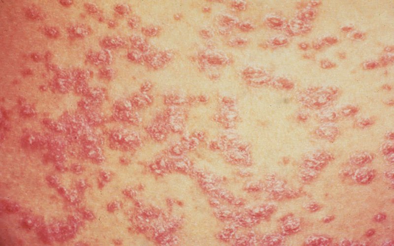 Hai loại bệnh vảy nến thể mủ phổ biến