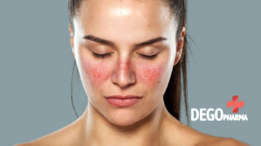 Bệnh vảy nến ở mặt