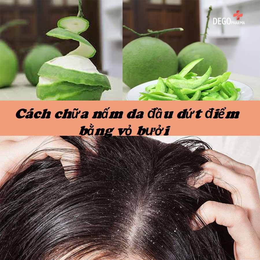 Thuốc trị nấm da đầu