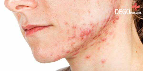 CÁCH CHỮA VIÊM DA TIẾT BÃ