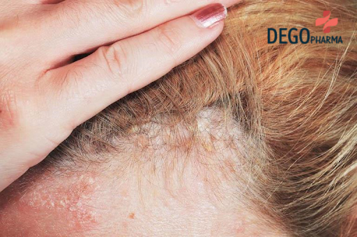 Cách Chữa Vẩy Nến Da Đầu Tại Nhà