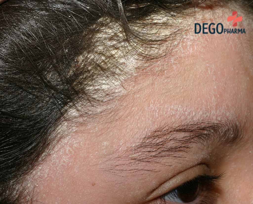 Gầu trên da đầu