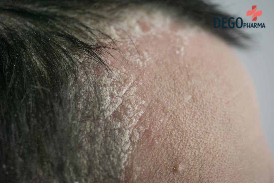 chữa trị mảng gàu trắng