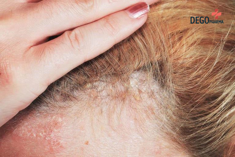 Dầu gội trị vảy nến da đầu