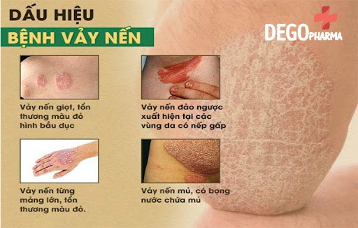 Triệu chứng bệnh vảy nến mặt như thế nào?
