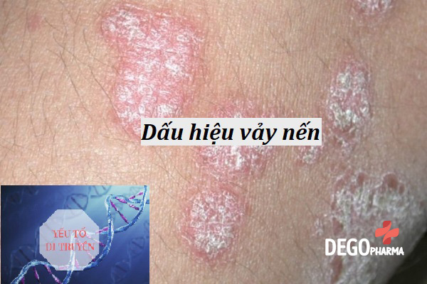 Triệu chứng vảy nến thông thường
