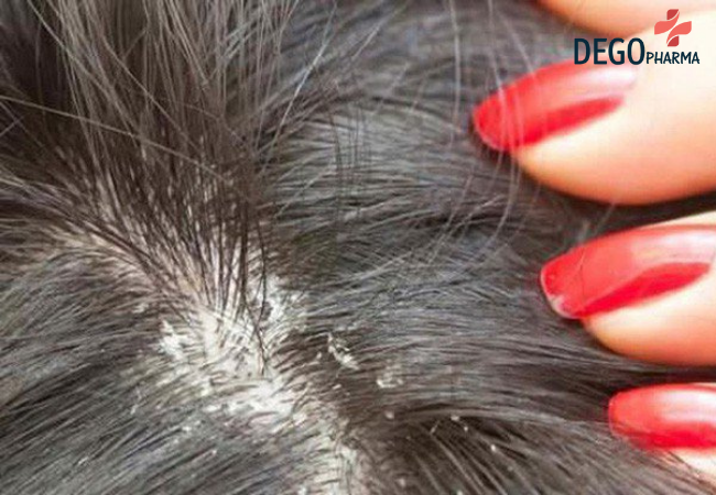 cách trị nấm da đầu