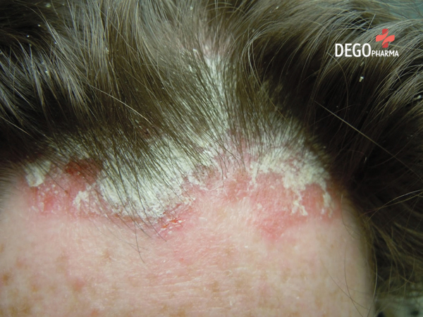 viêm da đầu gây rụng tóc
