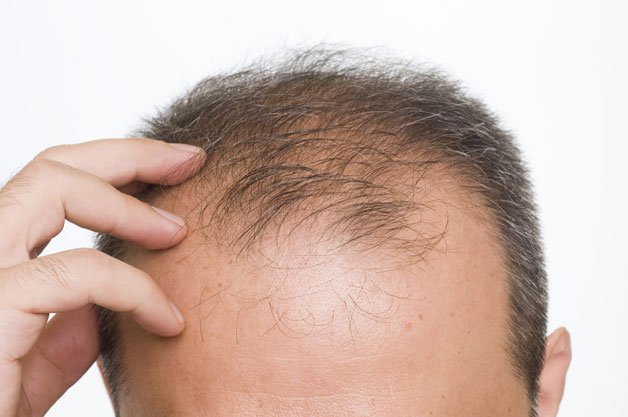 Nguyên nhân và bật mí cách chữa tình trạng rụng tóc