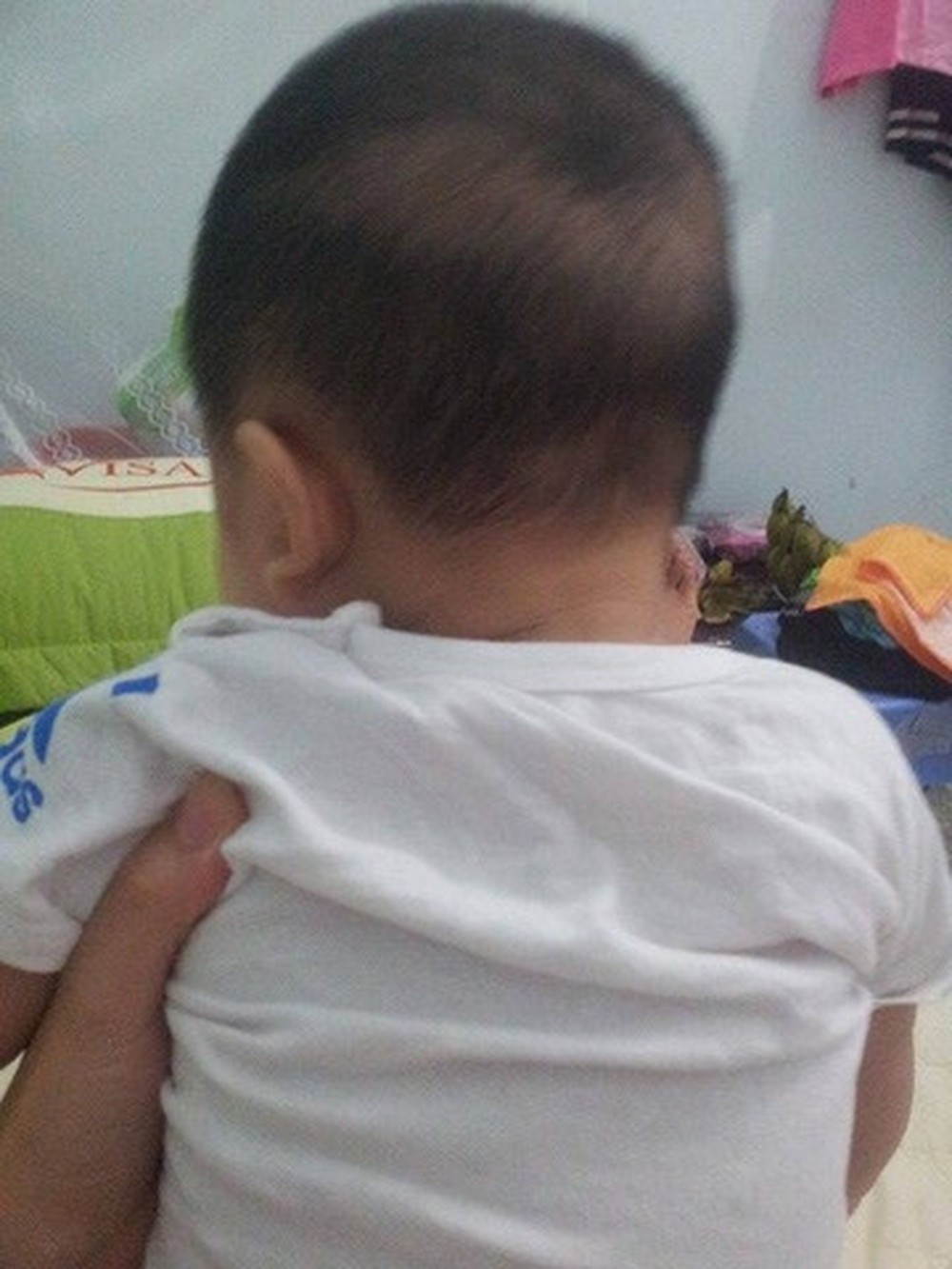 Phòng ngừa rụng tóc vành khăn