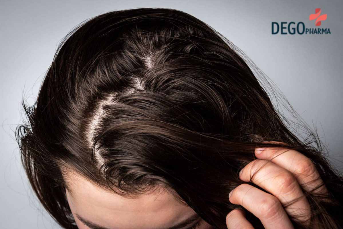 trị gàu nấm da đầu