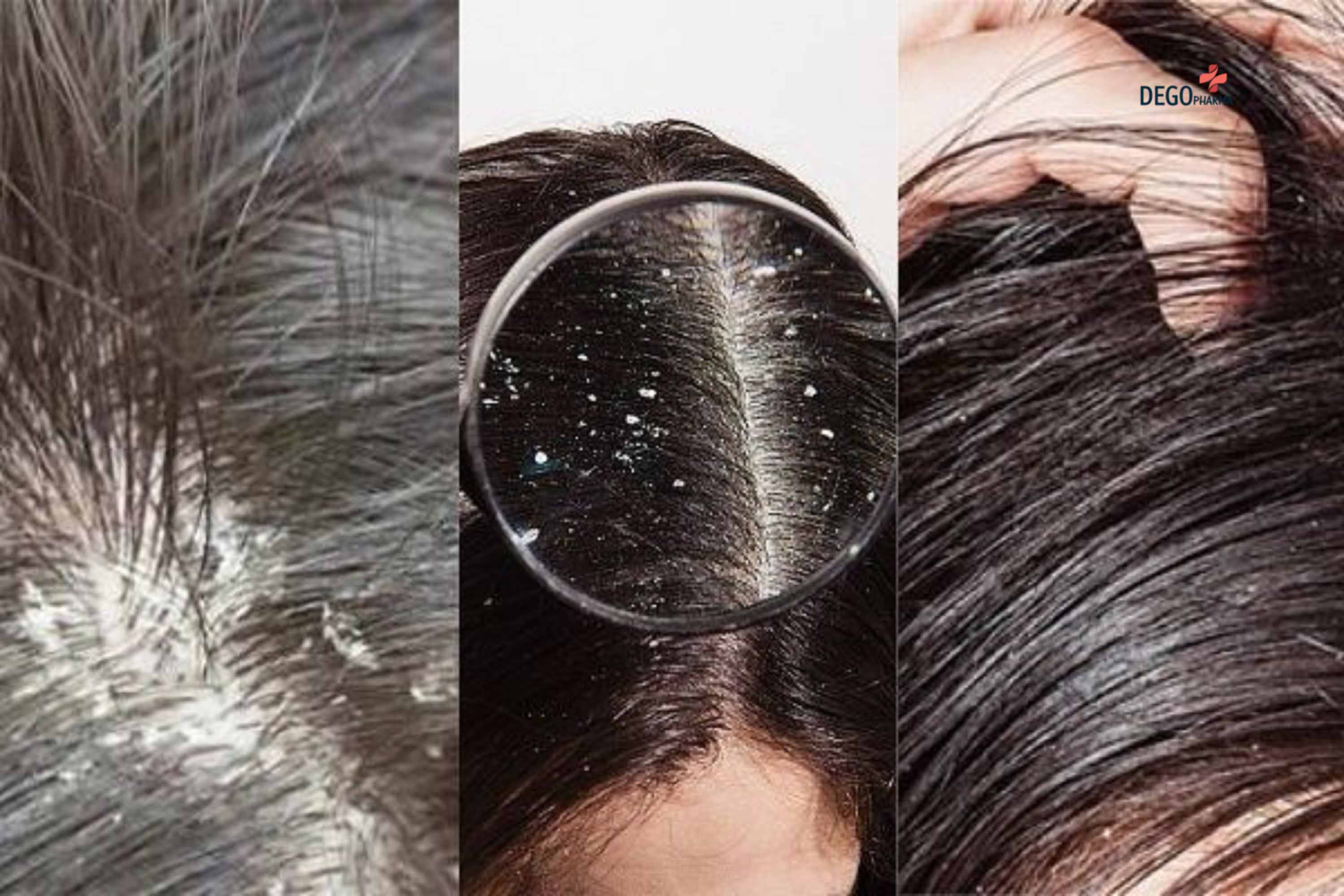 Dầu gội trị gàu