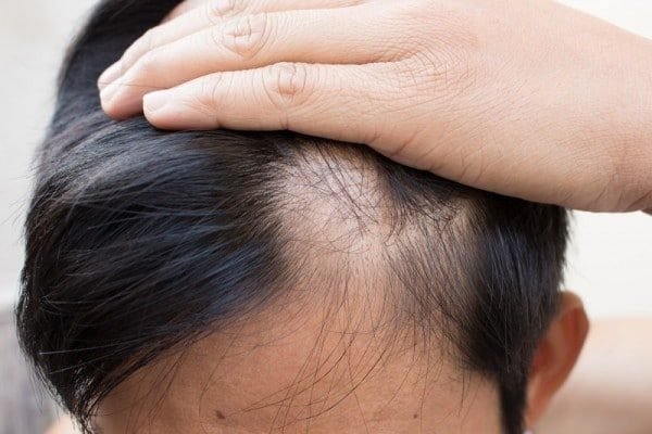 Ai có nguy cơ gặp tình trạng rụng tóc cao?