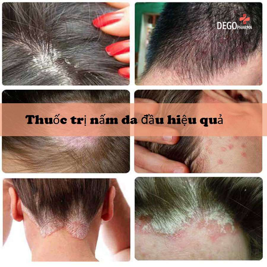 Triệu chứng nấm da đầu
