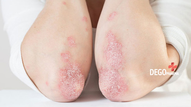 Triệu chứng bệnh vảy nến