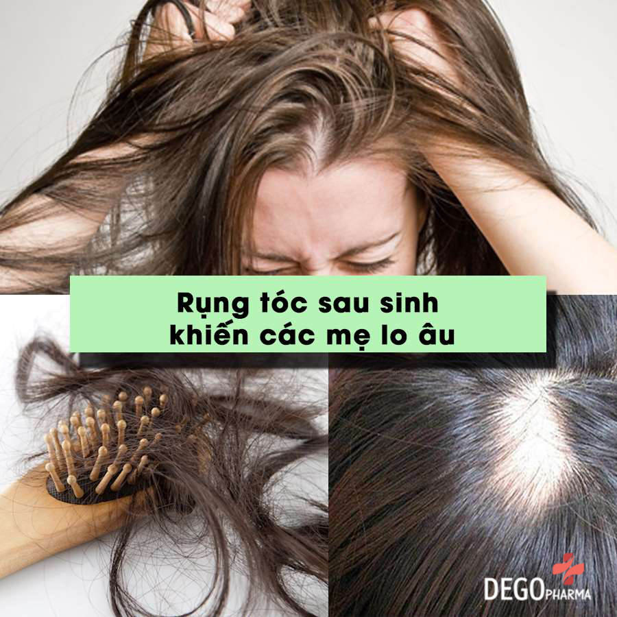 trị rụng tóc sau sinh