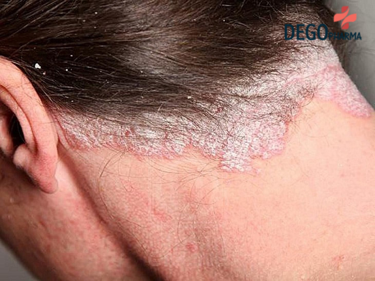 Cách Trị Vảy Nến Da Đầu Bằng Lá Trầu Không