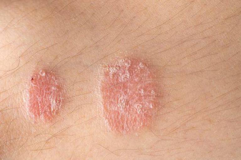 Điều trị vảy nến hồng