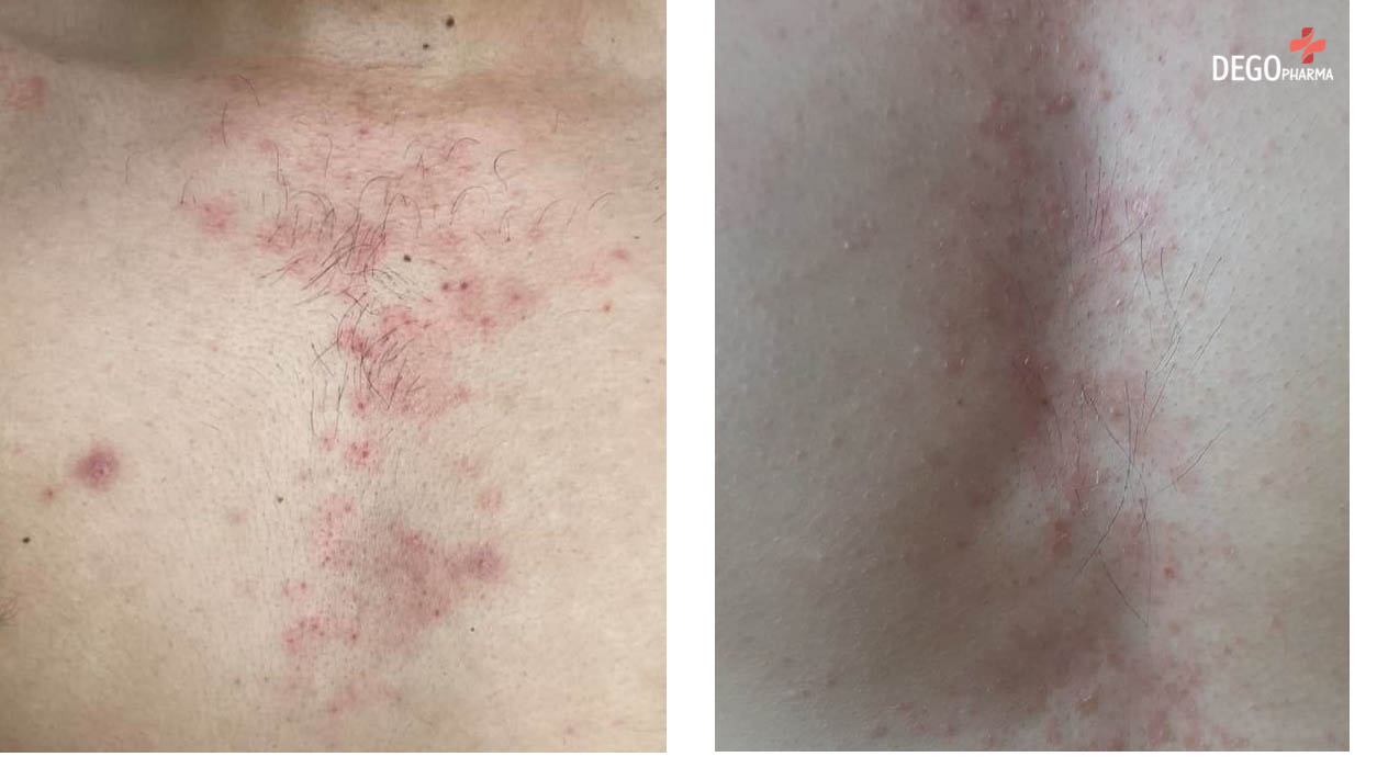 Viêm da tiết bã ở da đầu