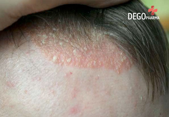 Chữa viêm da tiết bã da đầu ngay tại nhà đơn giản