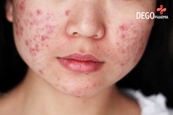 điều trị viêm da tiết bã