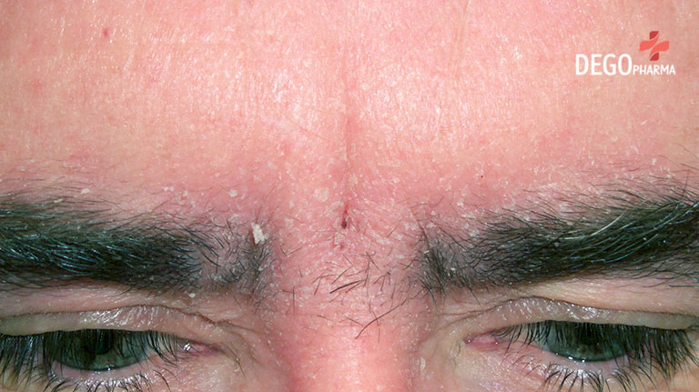 Viêm da tiết bã ở mặt có những cách nào để điều trị hiệu quả?