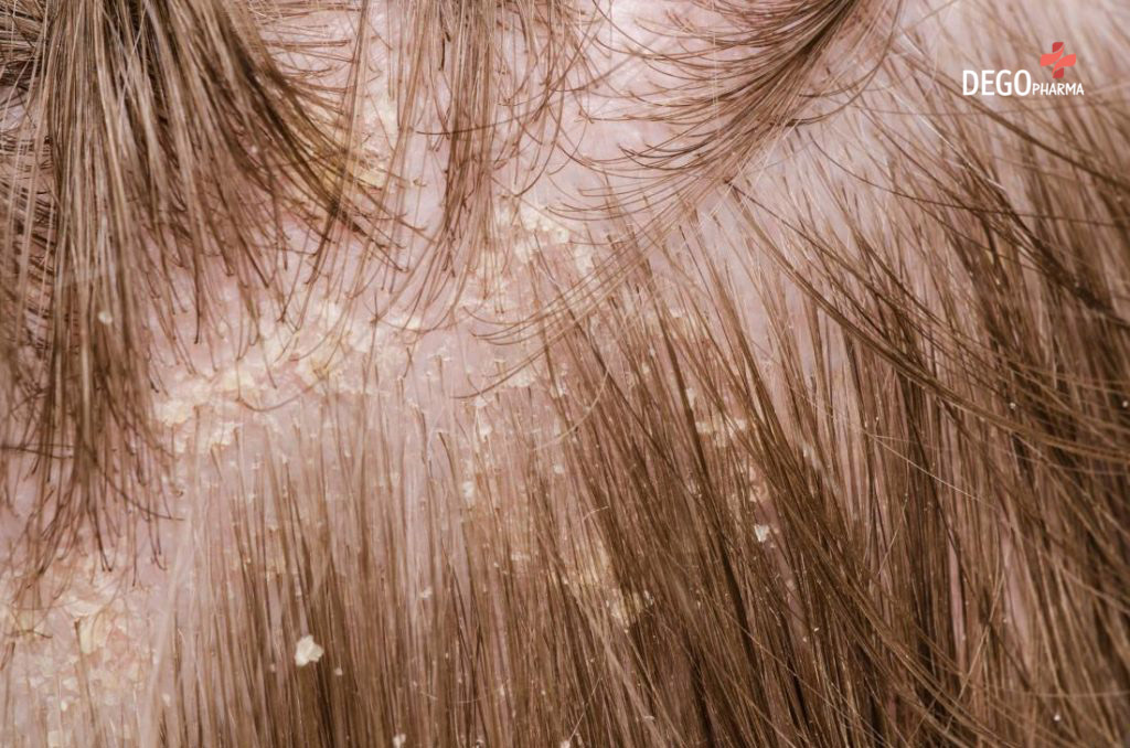 Cách trị viêm da tiết bã tại nhà