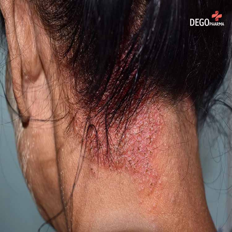Viêm da tiết bã
