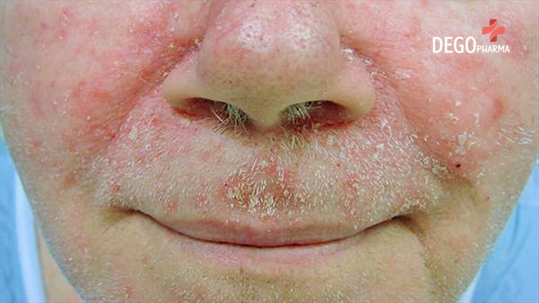 Bật mí cách trị viêm da tiết bã tận gốc