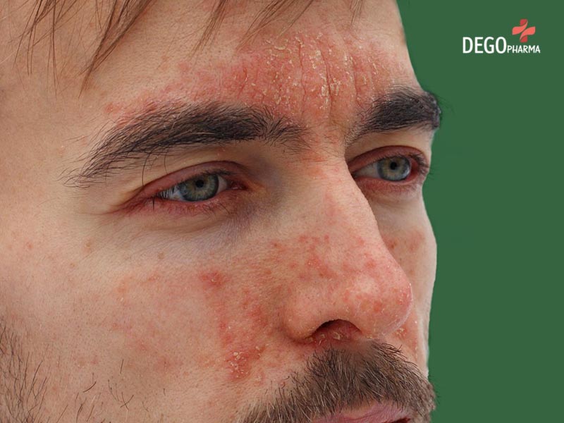 Bật mí cách trị viêm da tiết bã tận gốc