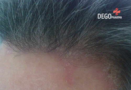 Triệu chứng nấm da đầu