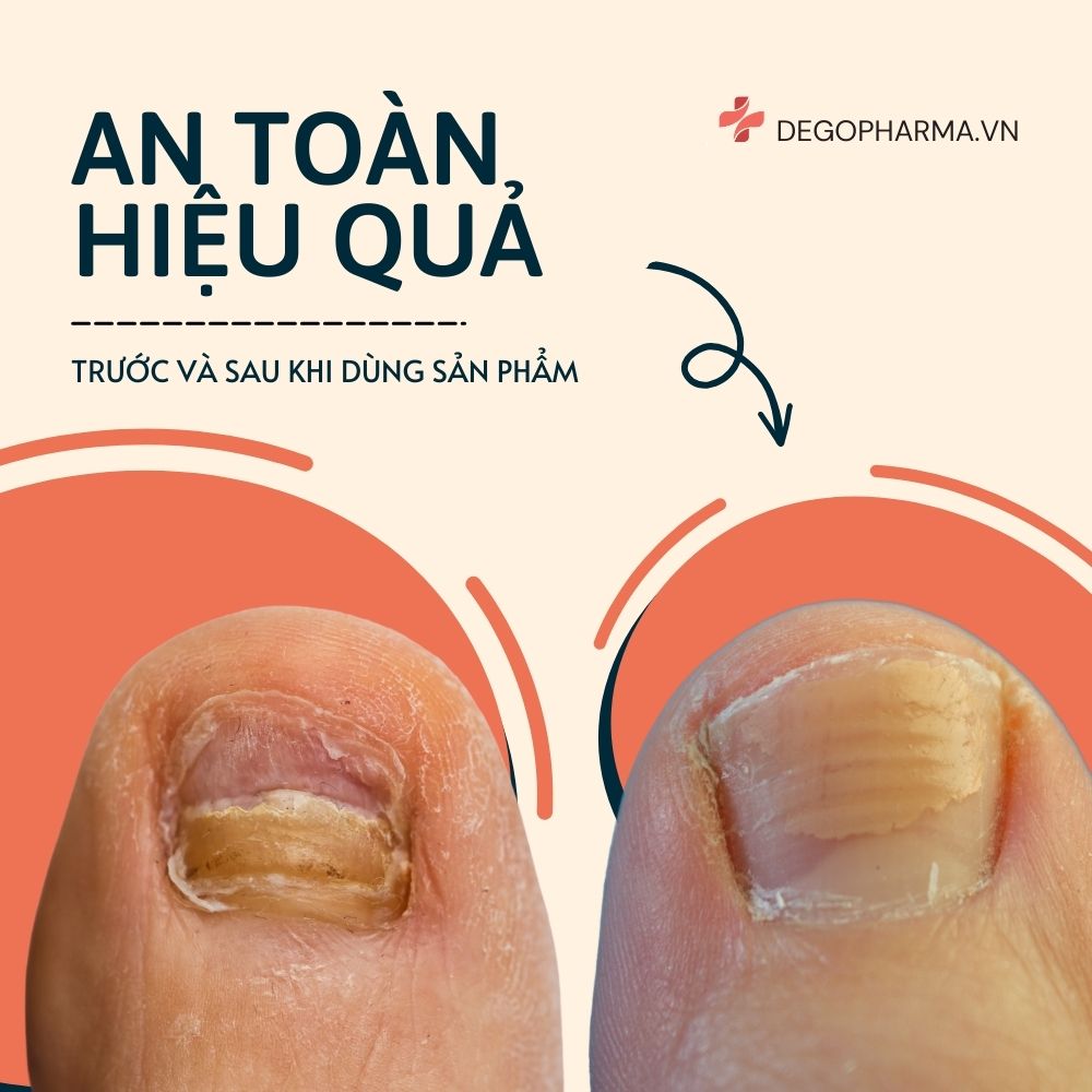 Đánh giá hiệu quả của thuốc trị nấm móng tay Dego Pharma