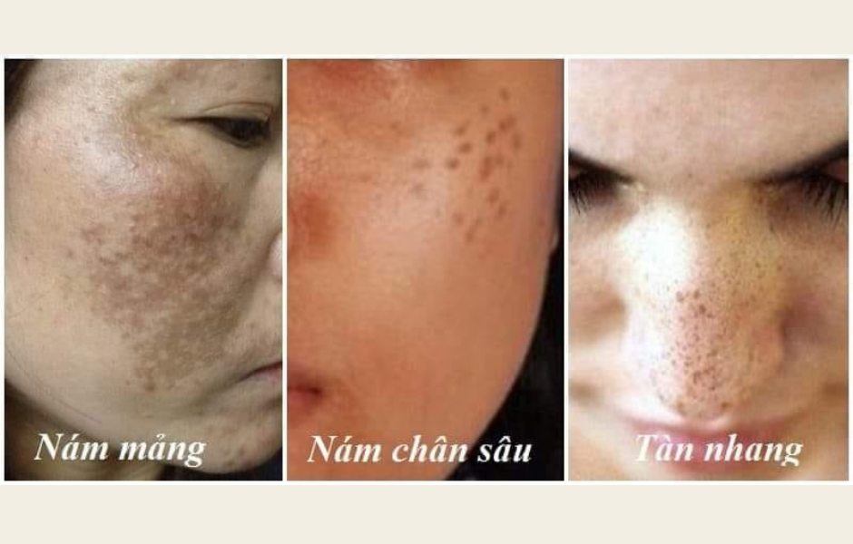 BẠN ĐANG BỊ NÁM DA HAY TÀN NHANG?
