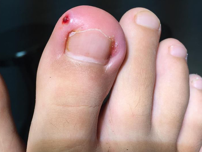 Khi bị gãy móng chân cần bổ sung thực phẩm gì để hồi phục?