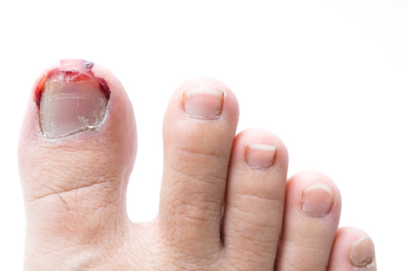 Sử dụng Gel Poly