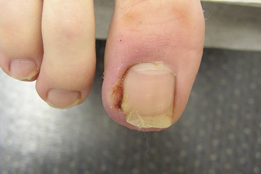 Nguyên nhân gãy móng chân