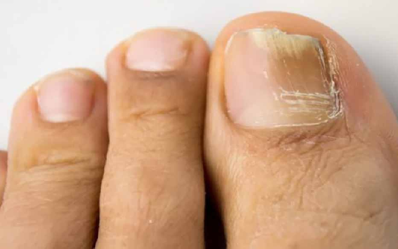 Những nguyên nhân khiến móng chân bị gãy