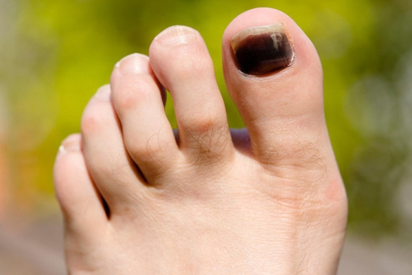 Nguyên nhân nào khiến cho móng chân bạn bị đen?