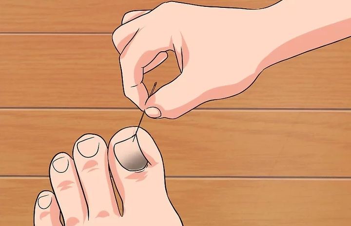 Gãy móng chân phải làm sao?