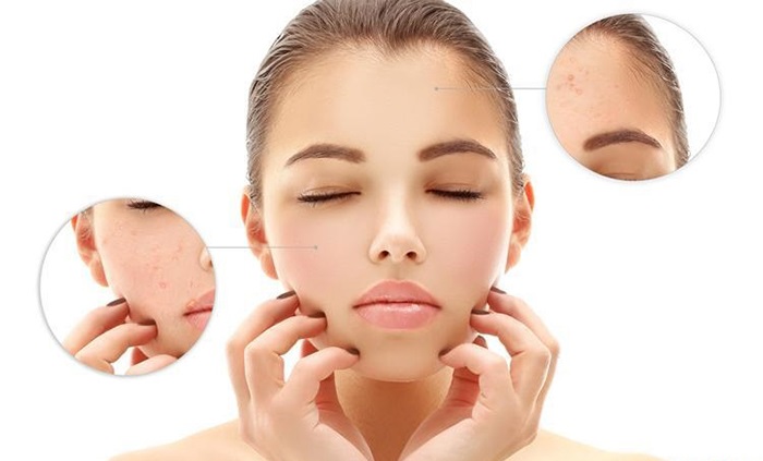 ngăn ngừa thâm mụn