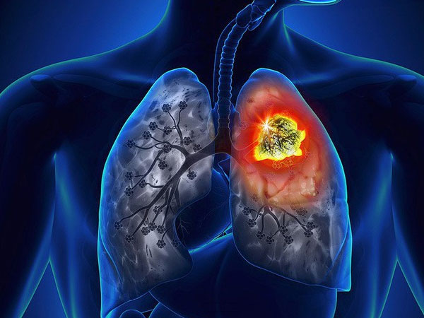 Dấu hiệu của bệnh viêm phổi ở người lớn