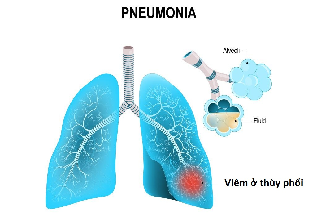 Dấu hiệu nhận biết bệnh viêm phổi thùy bạn nên biết